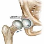 labral tear hip treatment