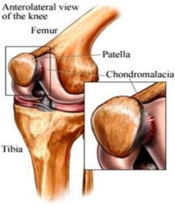 Chondromalacia Patella