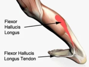 Flexor Hallusis Longus Tenosynovitis