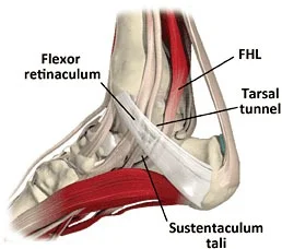 Flexor Hallusis Longus Tenosynovitis1