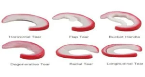 Meniscus Tear2