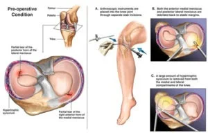 Meniscus Tear7