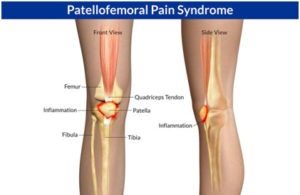 Patellofemoral Pain Syndrome