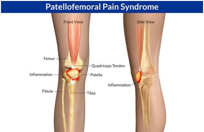 Patellofemoral Pain Syndrome Causes, Symptoms and Treatment | PFP