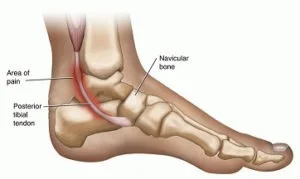 Posterior Tibialis Tendonitis1