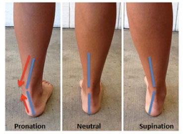 Posterior Tibialis Tendonitis/Rupture Treatment | Physiotherapy In Delhi