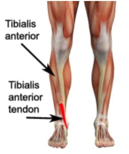 Tibialis Anterior Tendonitis Treatment in Delhi | Pain Free Physiotherapy