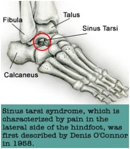 Sinus Tarsi Syndrome
