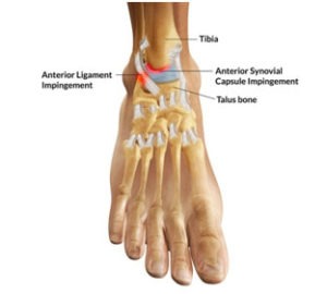 Anterolateral Impingement