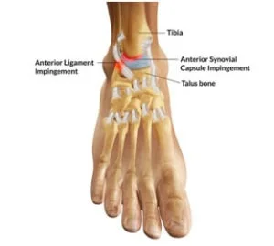 Anterolateral Impingement