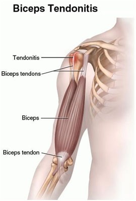 Biceps Tendonitis Treatment in Dwarka, Delhi | Pain Free Physiotherapy