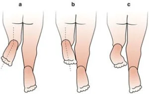 faulty alignment of the hip, knee, or foot abnormalities