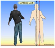 Antalgic gait