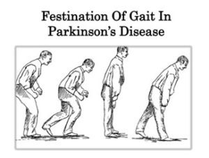 Parkinson’s gait/ Festinating gait