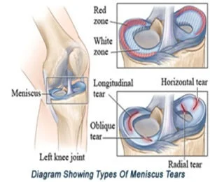 Meniscus Tear