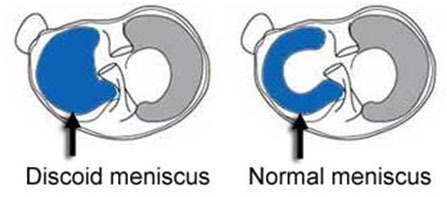 Discoid Meniscus