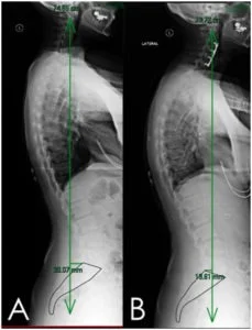 Postural Assessment Physiotherapy