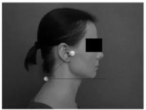 Postural Assessment Physiotherapy