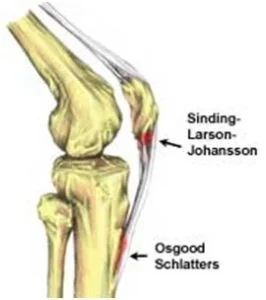 Sinding Larsen Johansson Syndrome