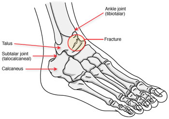 Stress Fracture of Talus Treatment in Dwarka & Janakpuri, Delhi