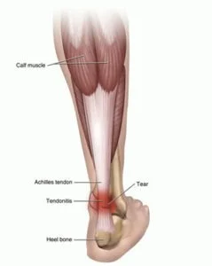 Tendinitis