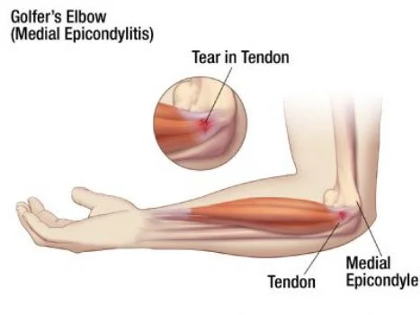 Golfer's Elbow 