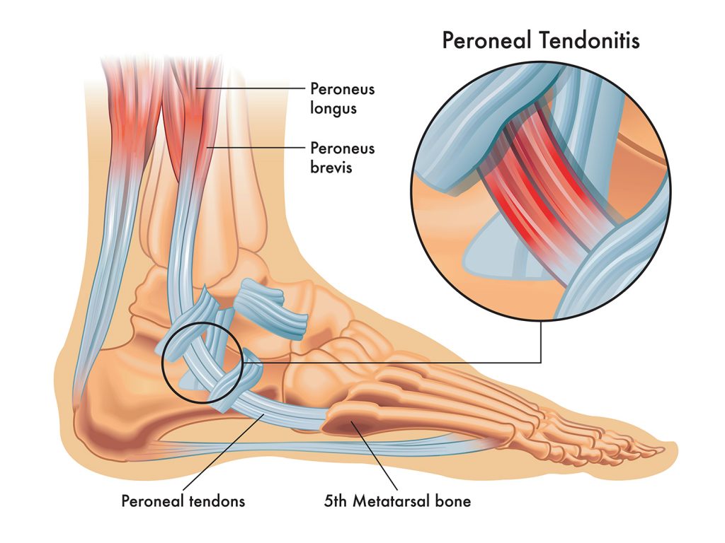 peroneal tendonitis | Painfree
