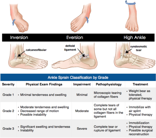 Grades of severity of ankle sprain