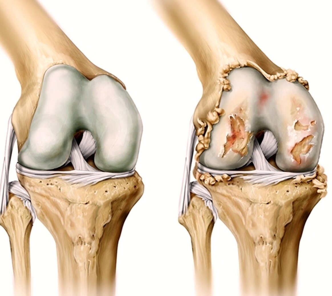 Knee osteoarthritis