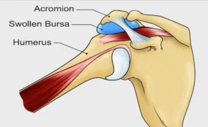 Shoulder-Bursitis