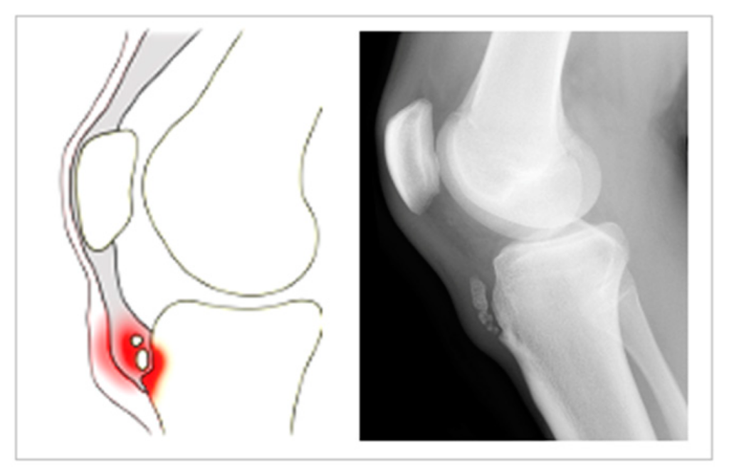 Osgood Schlatter’s Disease