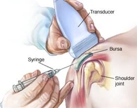 treatment of Shoulder Bursitis
